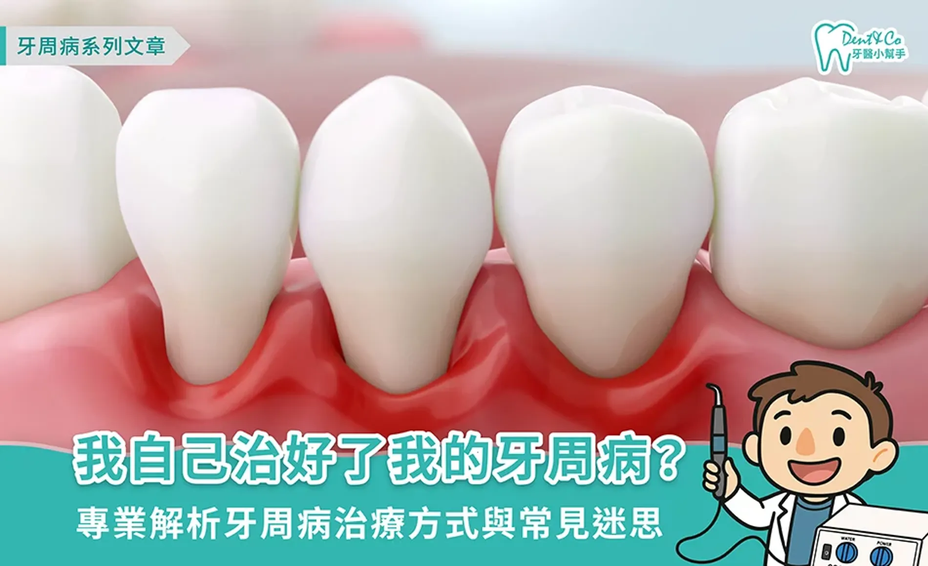 我自己治好了我的牙周病？專業解析牙周病治療方式與常見迷思