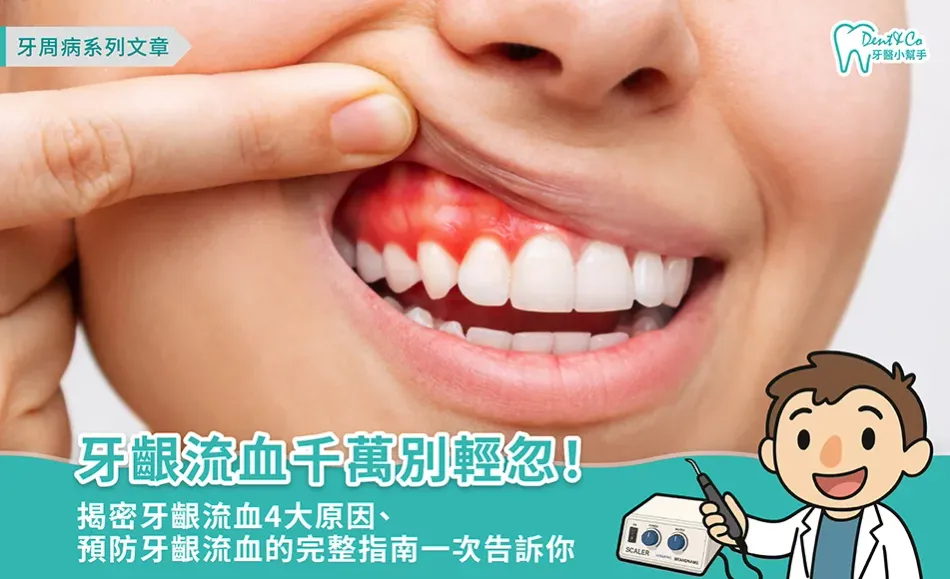牙齦流血千萬別輕忽！揭密牙齦流血4大原因、預防牙齦流血的完整指南一次告訴你