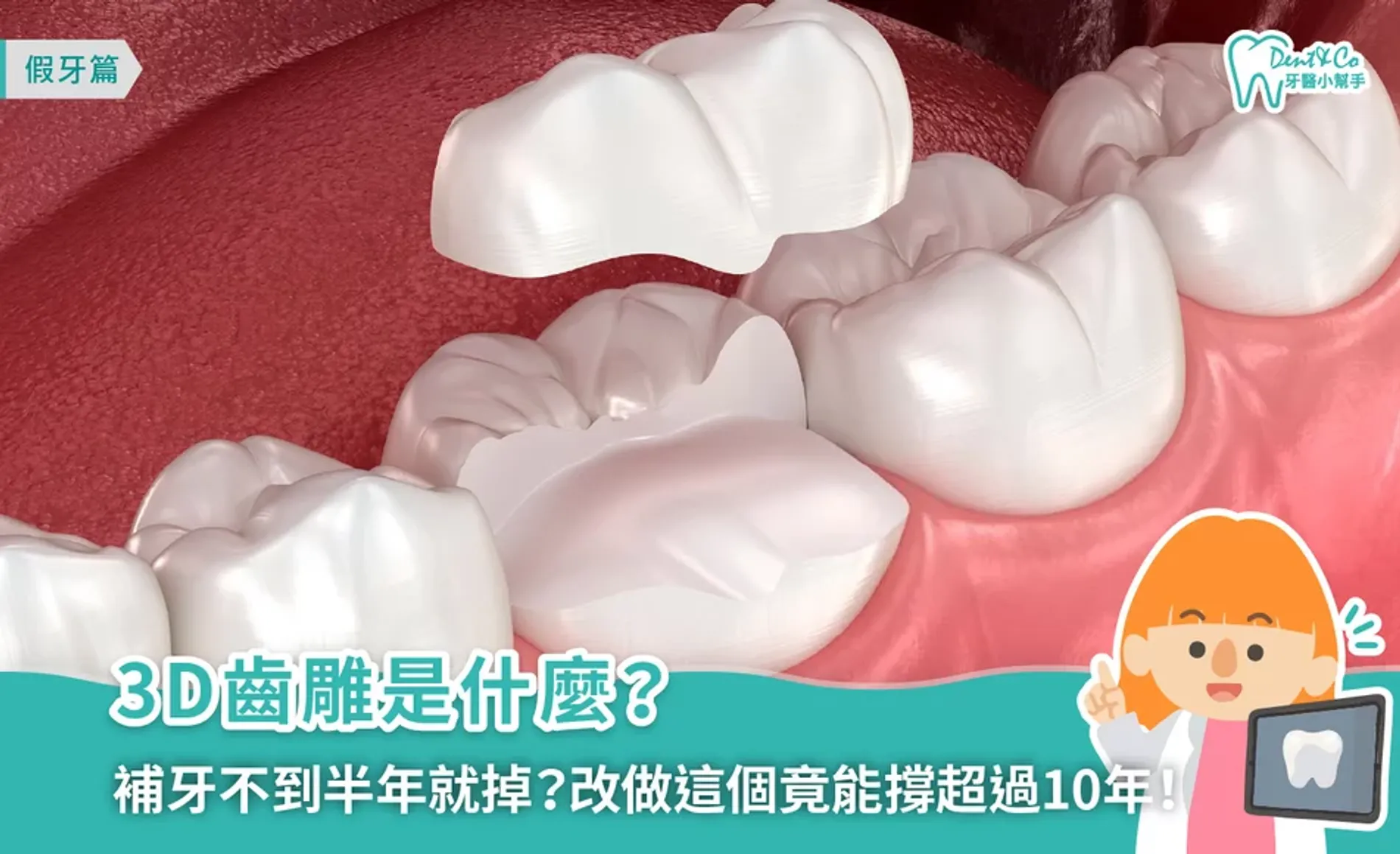 3D齒雕是什麼？優缺點、價格、材質、治療流程一次了解！