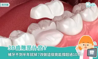 3D齒雕是什麼？優缺點、價格、材質、治療流程一次了解！