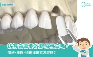 拔智齒需要放膠原蛋白嗎?價格、原理、術後掉出來怎麼辦看這篇!