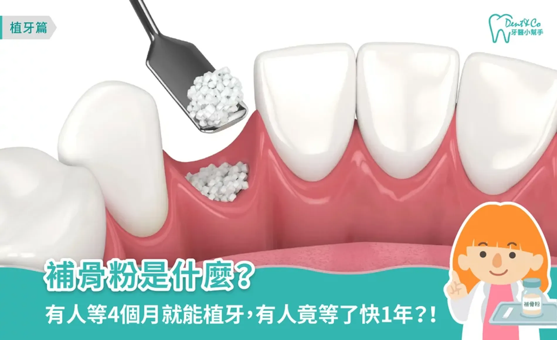 補骨粉是什麼？多久可以植牙、後遺症與注意事項一次了解