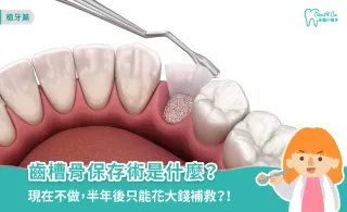 齒槽骨保存術是什麼?原理、多久可以植牙以及適合情況全攻略