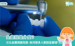 全瓷冠是什麼？從材質、壽命、療程至保養方式全解析！