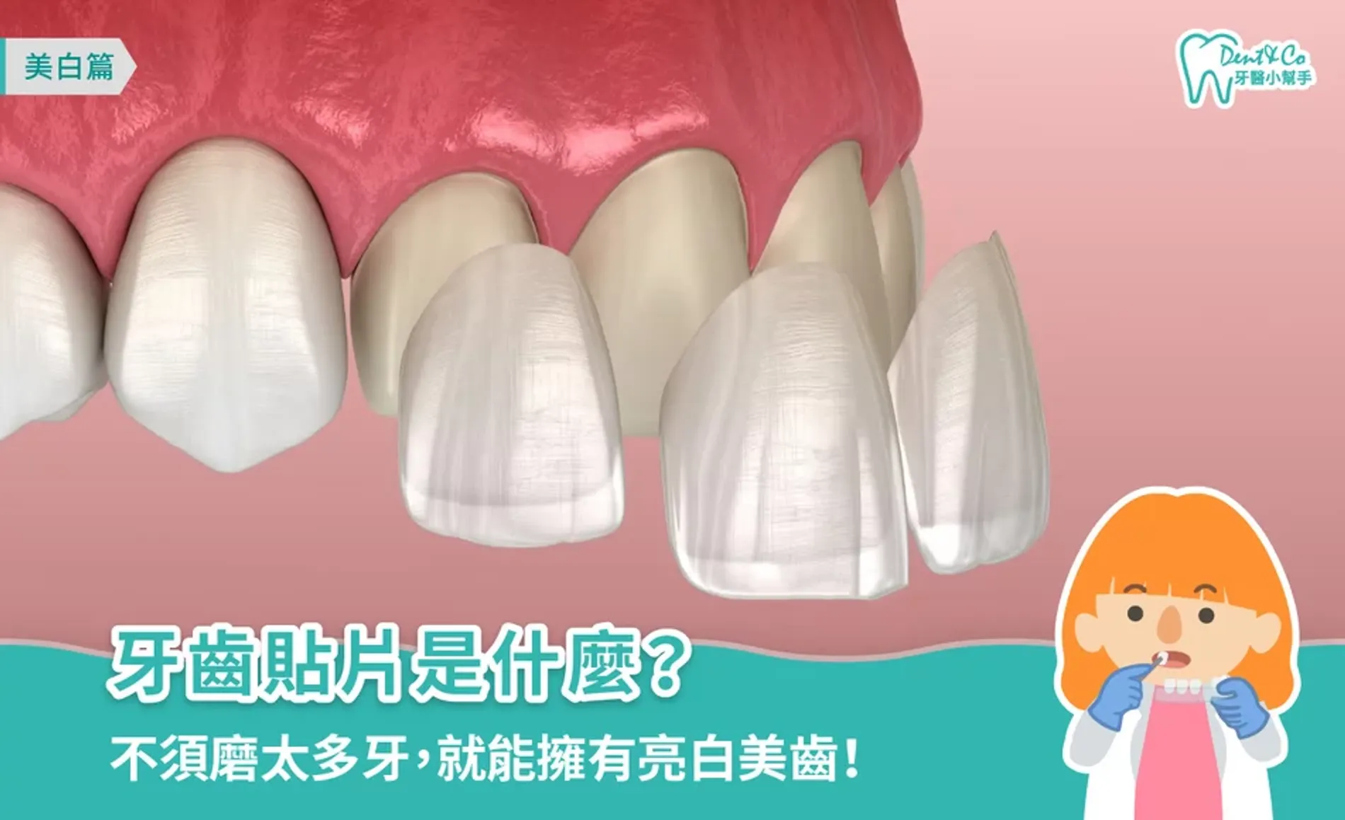牙齒貼片是什麼？優缺點、適合情況與後遺症一次了解！