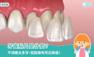 牙齒貼片是什麼？優缺點、適合情況與後遺症一次了解！