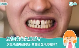 牙縫變大怎麼辦？專業牙醫解析常見原因、蛀牙風險與補牙費用