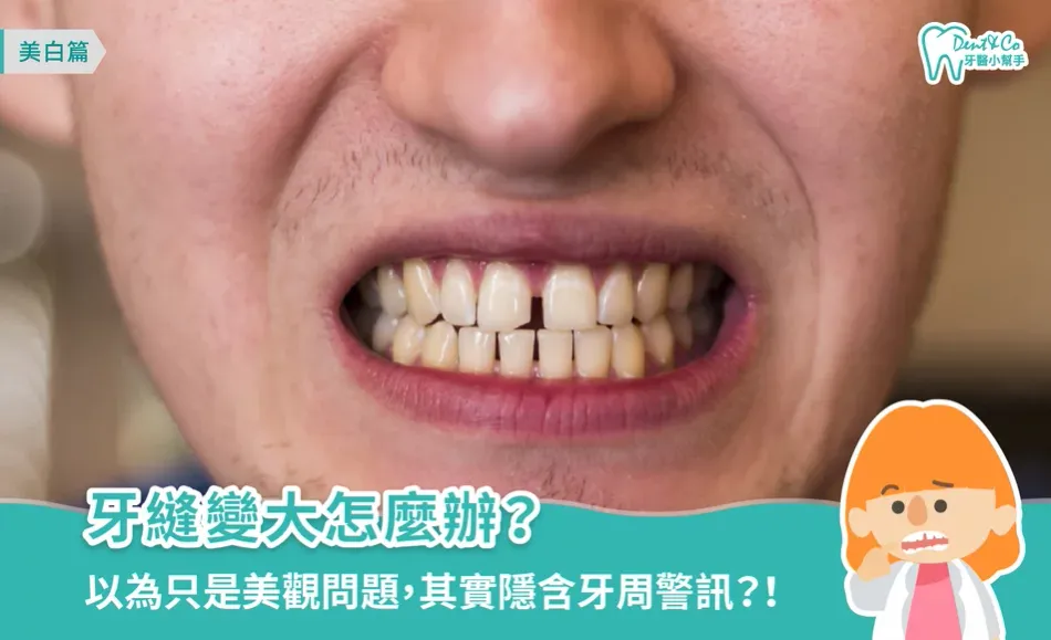 牙縫變大怎麼辦？專業牙醫解析常見原因、蛀牙風險與補牙費用