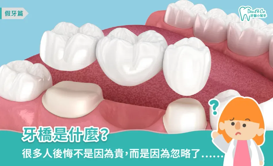牙橋是什麼？價格、結石清潔與保養方式一次看懂