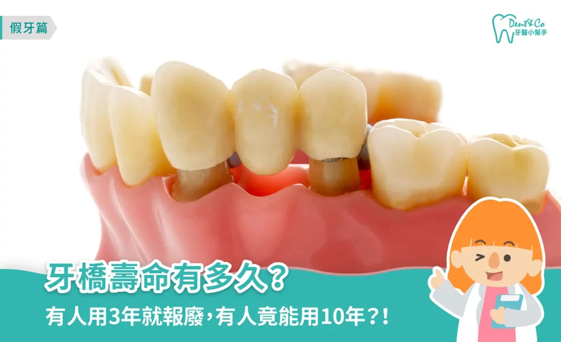 牙橋壽命有多久？專業醫師解析影響年限原因與清潔保養方法
