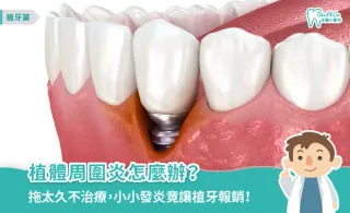 植體周圍炎怎麼辦?一篇搞懂7大原因、8個症狀、治療與預防方式!