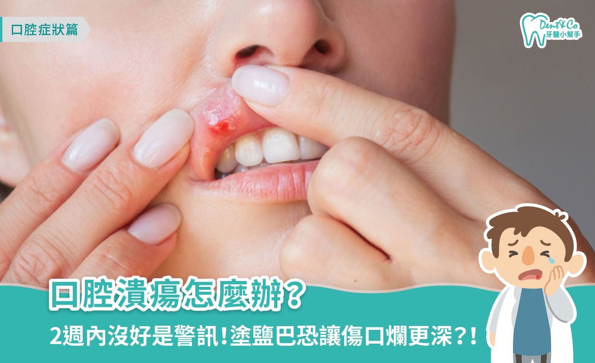口腔潰瘍怎麼辦？成因、5大種類、快速復原和預防方法全攻略