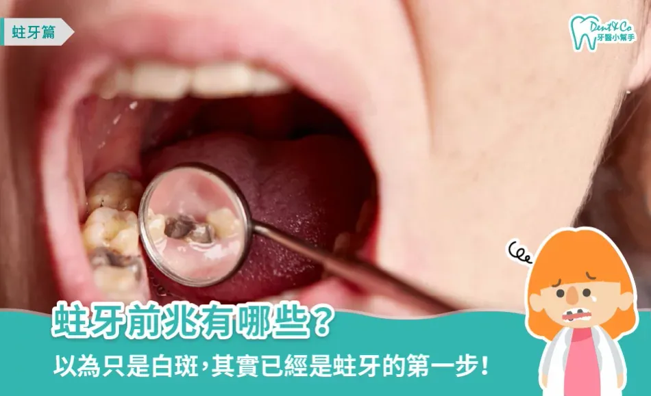 蛀牙前兆有哪些？牙醫教你辨識「脫鈣白斑」與初期蛀牙徵兆