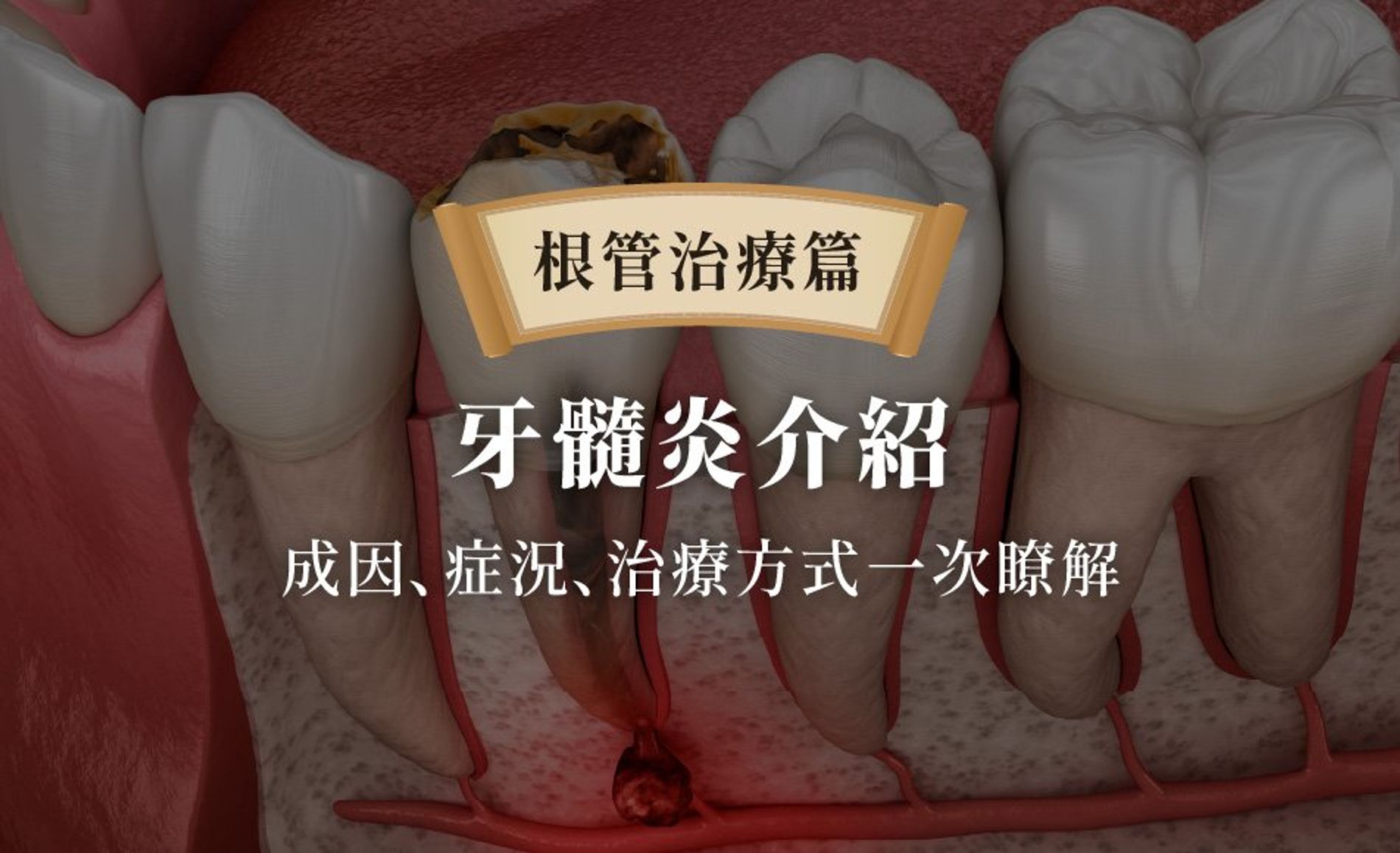 牙髓炎介紹：成因、症況、治療方式一次瞭解