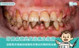 認識牙周病：原因、症狀、治療法以及照護注意事項