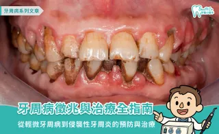 認識牙周病：原因、症狀、治療法以及照護注意事項
