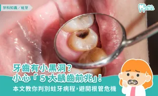 牙齒有小黑洞？小心「5大齲齒前兆」！本文教你判別蛀牙病程，避開根管危機